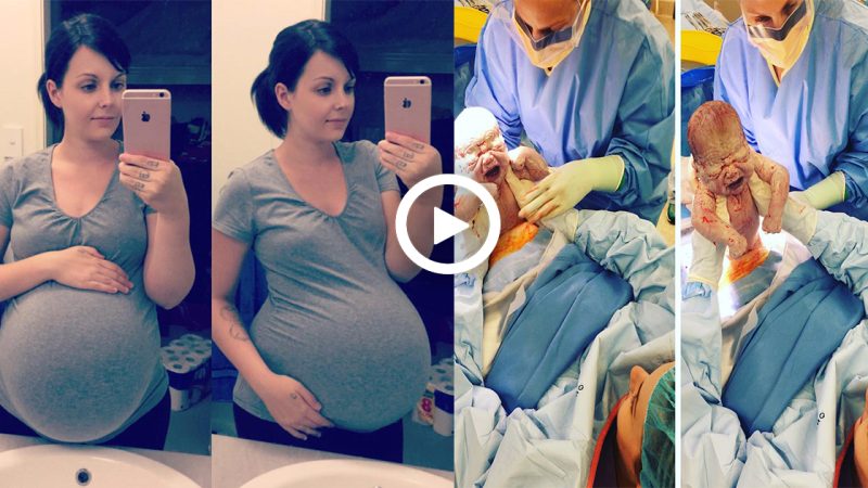 Amazing Scene: Mother Assists in Caesarean Section of Her Own Child.